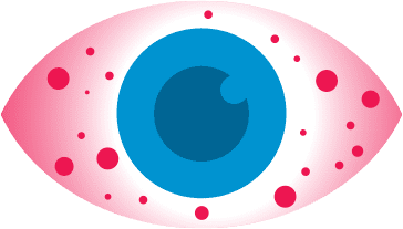 Nonspecific conjunctivitis eye icon. Blue eye, bery red and irritated with red dots within